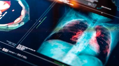 Lung Screening for Cancer