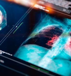 Lung Screening for Cancer