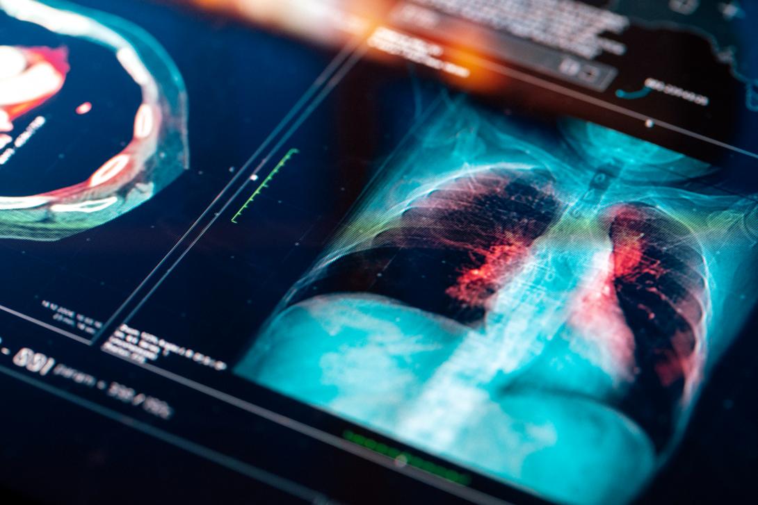 Lung Screening for Cancer